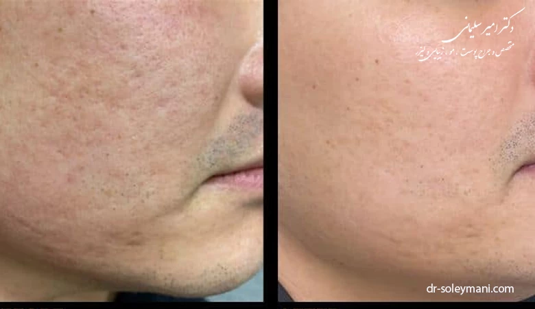 انواع لیزر برای درمان جای جوش