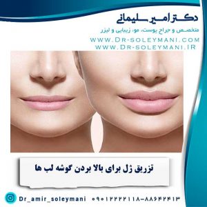 تزریق-ژل-لب