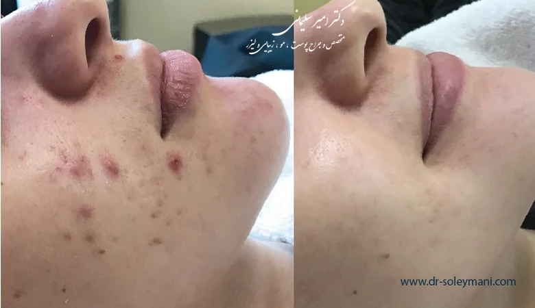 پانچ صورت برای رفع جای جوش چیست؟