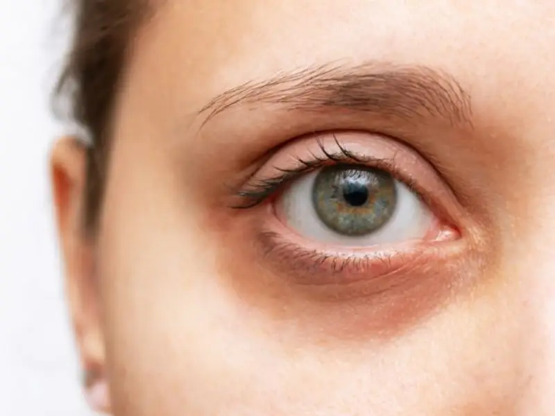 روش_های درمان سیاهی دور چشم